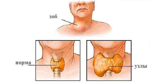 Щитовидная железа: дефицит витамина вызывает серьёзные нарушения её функций