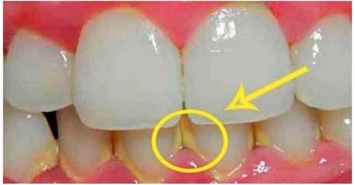 Зубной налет можно удалить без стоматолога за 5 минут!
